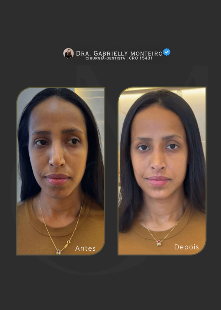 Antes e depois - PERFIL