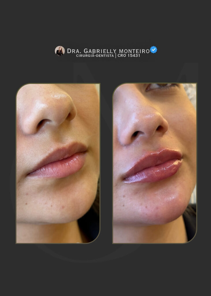 Preenchimento labial