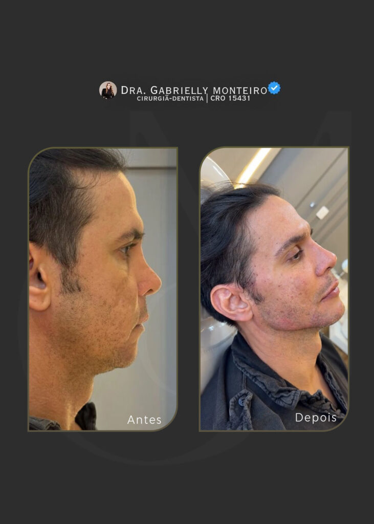 maxilar antes e depois