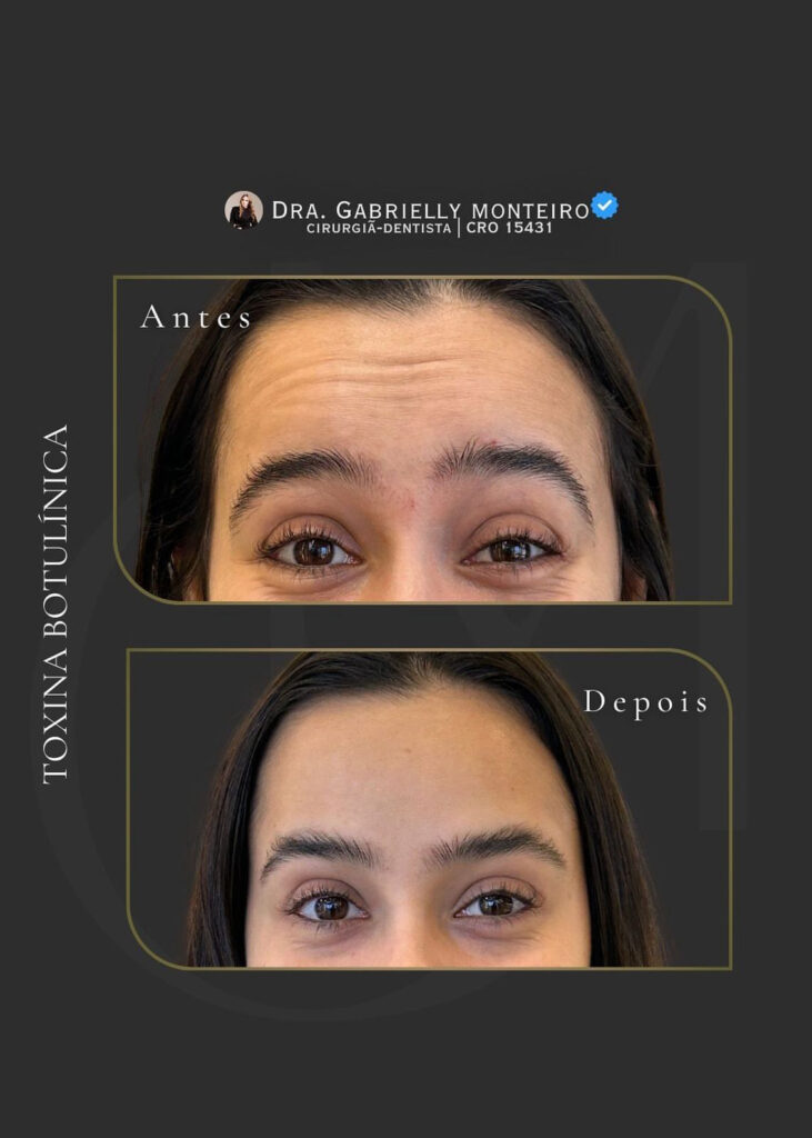 toxina butolinica- antes e depois